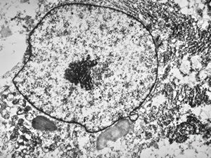 F,39y. | metastatic alveolar sarcoma of soft parts F,39y. | metastatic alveolar sarcoma of soft parts